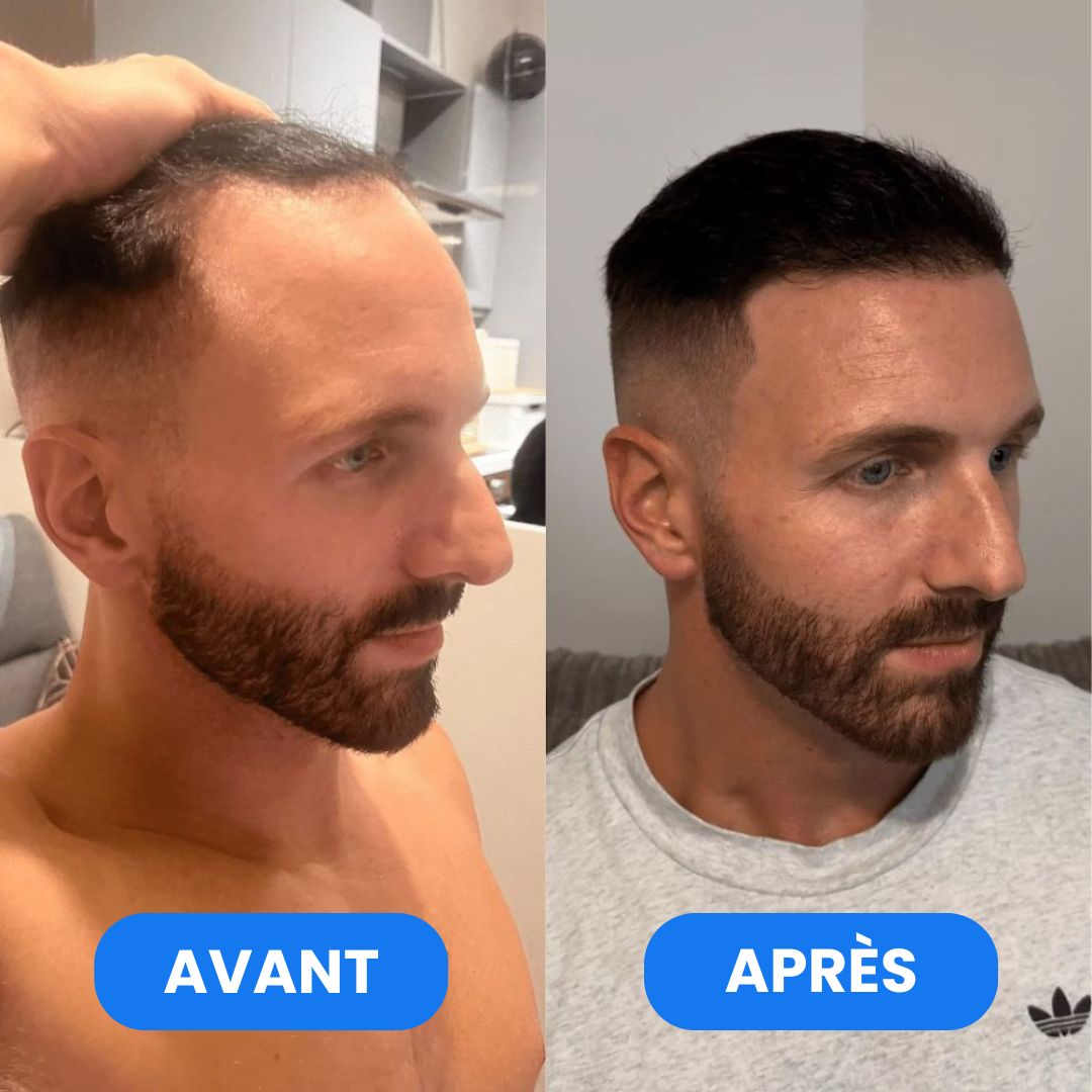 Sérum Roll-On Activateur de Pousse